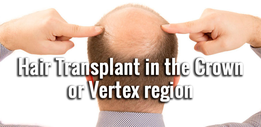 Hair Transplant In The Crown Or Vertex Region - FueCapilar